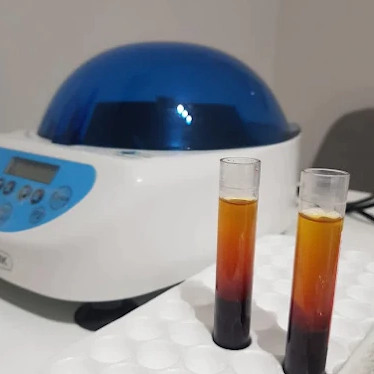 Plasma Rico en Plaquetas (PRP)