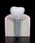 Implante Dental Desarmable