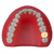 Dente Diferenciado 27 Classe I na Face Oclusal Prodens (3376)