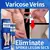 Pomada eliminadora de varizes - VenoClear - MS STORE
