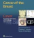 Cancer of the Breast