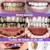 Imagem do Kit Dentes branqueamento creme dental caneta remover manchas de placa limpeza hi