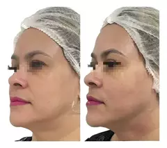Ultraformer MPT – A Revolução HIFU em Sua Clínica - loja online