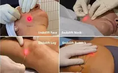 Endolift Endolaser 980nm 30W + 1470nm 3W – Lifting e Rejuvenescimento Não Invasivo na internet