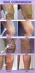 Caneta Bluelaser - Reparação de varizes, Rugas e Acne - loja online