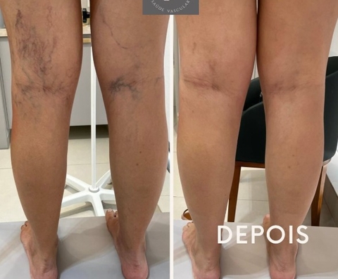 Pomada para veias varicosas elimina vasculite flebite para aliviar o tratamento