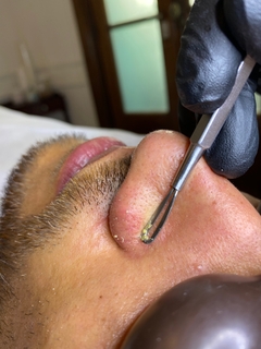 Limpieza Facial para hombres en palermo capital federal