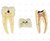 Dente Molar Inferior c/ Raiz Dupla em 3 Partes c/ Cárie, 8x o Tamanho Real Aprox. - SD-5059/E - Sdorf Scientific - comprar online